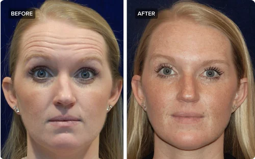 Botox treatment results