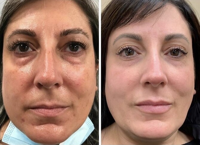 Chemical peel results