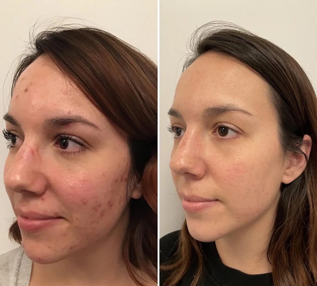 Hydra Treatment before and after