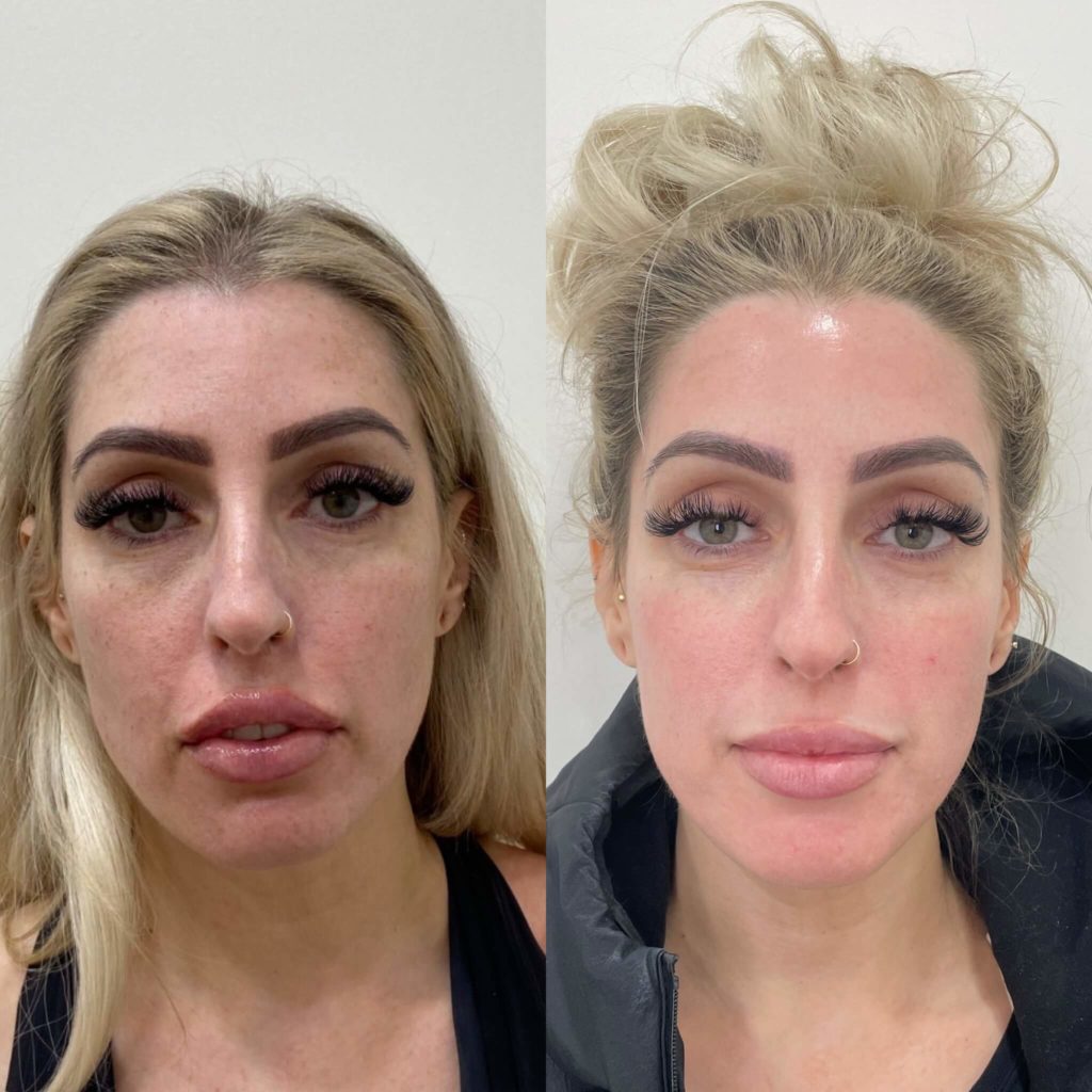 PRP PRF treatment results