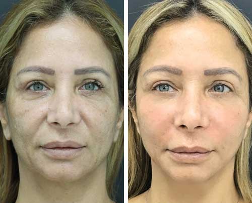 Skin rejuvenation results