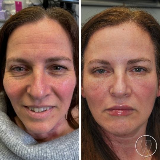Skin rejuvenation results