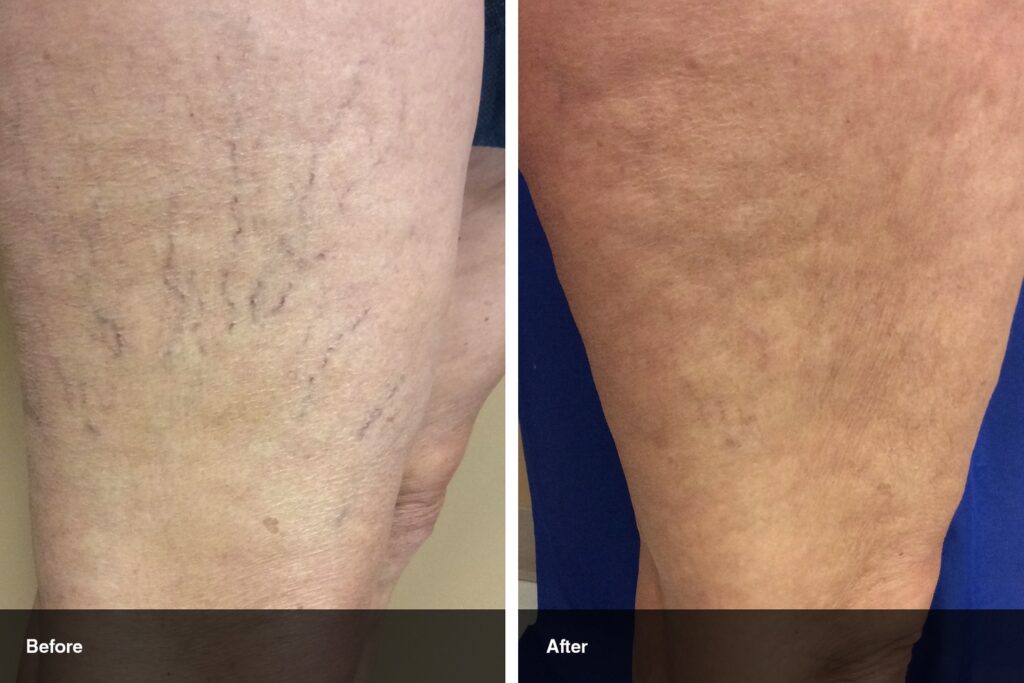 Spider vein removal results