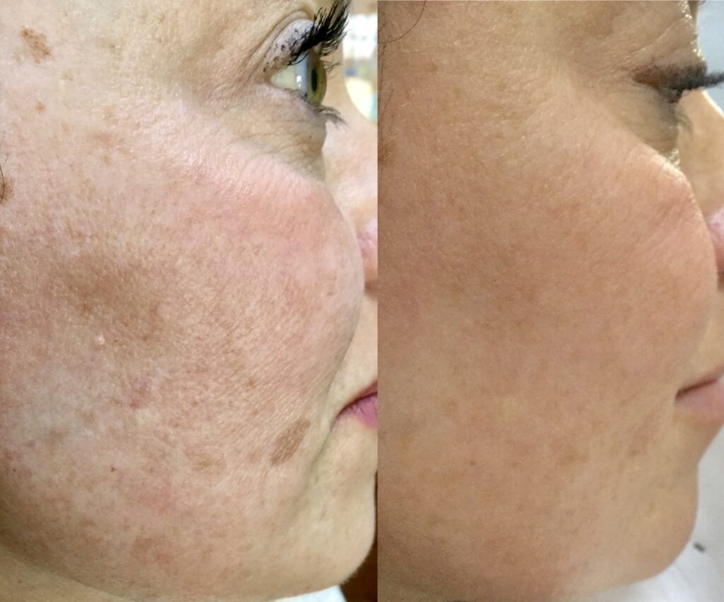 Pigmentation Treatment