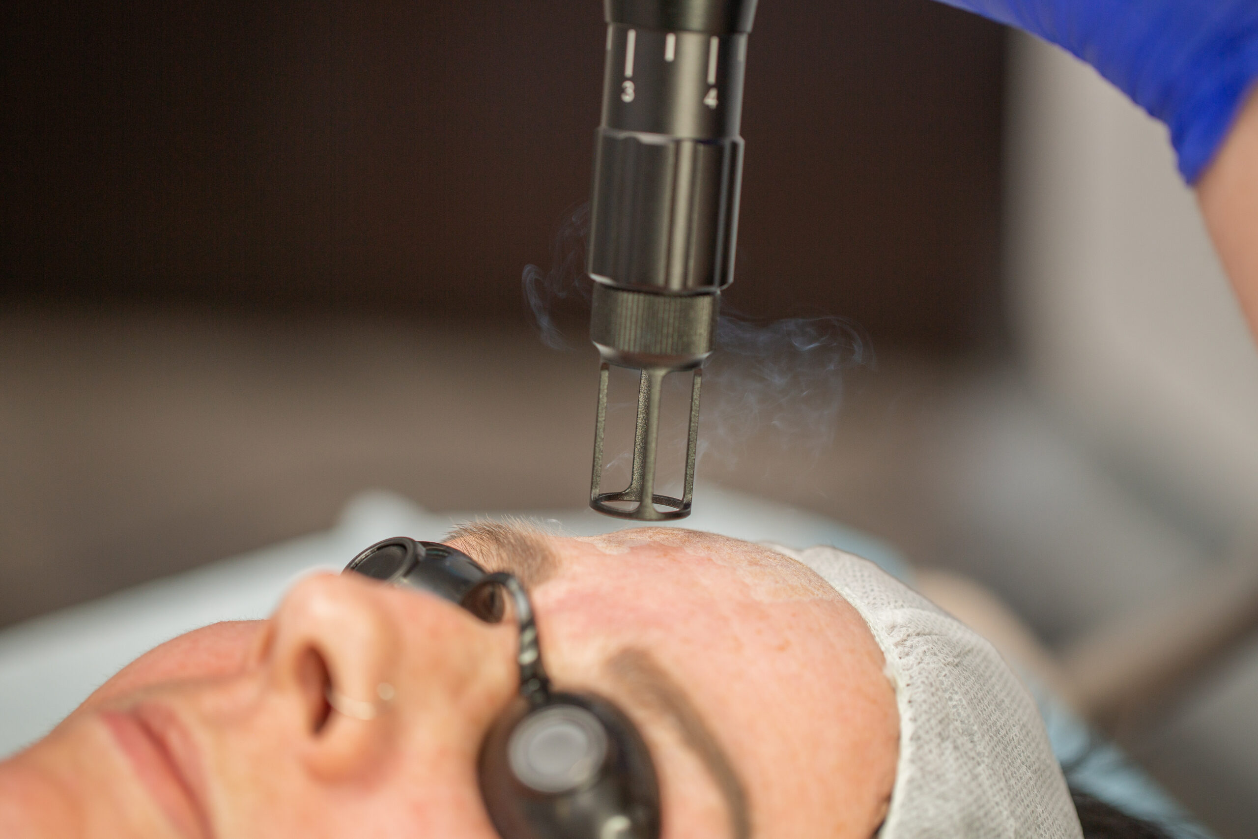 Achieve Remarkable Skin Transformation with Erbium YAG Laser at Nova Med Spa