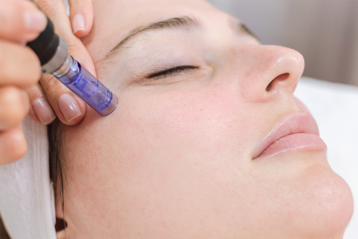Microneedling: The Revolutionary Art of Skin Renewal at Nova Med Spa