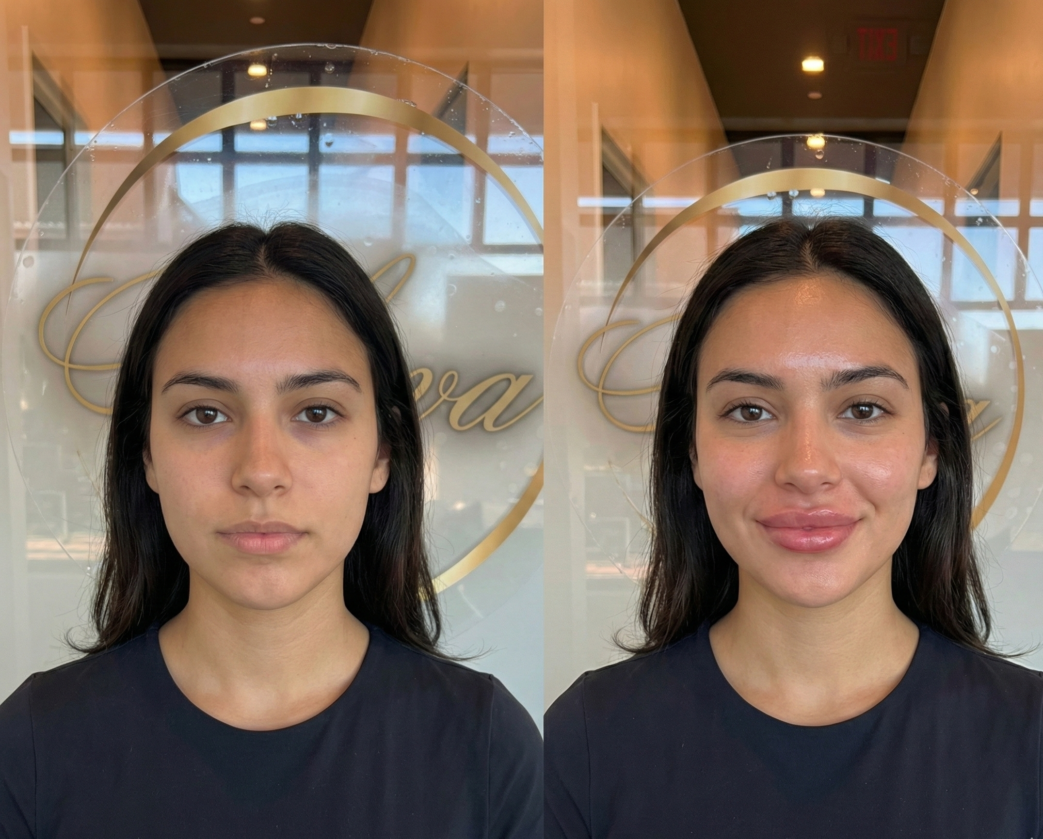 Rediscover Your Youthful Glow With Dermal Fillers at Nova Med Spa