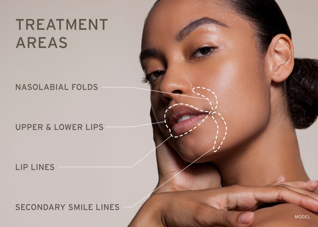 Revitalize Your Look with RHA Fillers at Nova Med Spa